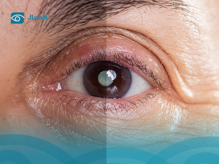 علاج نزيف شبكية العين بالليزر