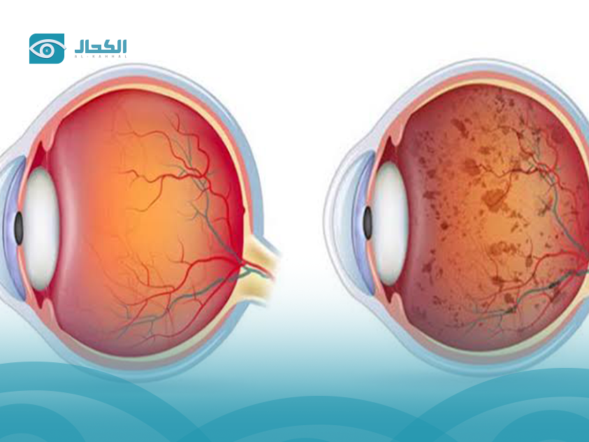 اعتلال-الشبكية-الصباغي