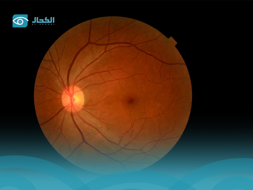 diabetic-eye-screening