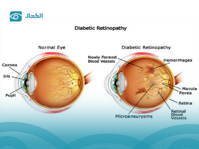 retinopathy-treatment