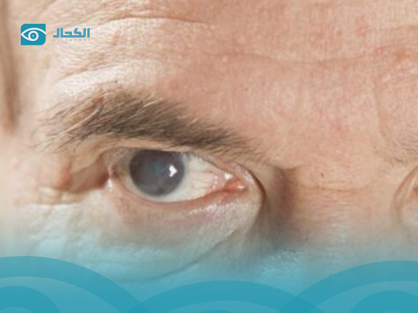 عملية كتراكت العين