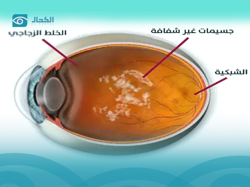ذبابة-العين
