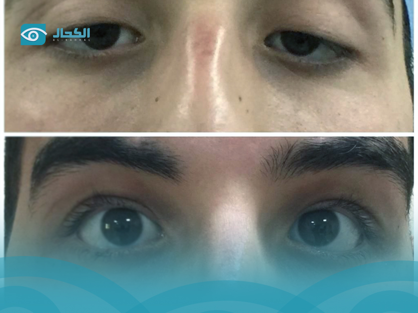 ارتخاء-الجفن
