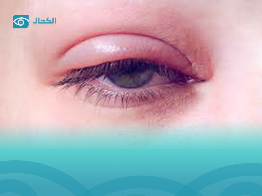 سبب-انتفاخ-جفن-العين-العلوي
