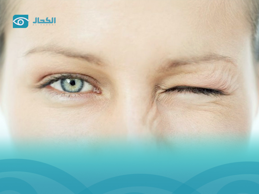 علاج-تشنج-جفن-العين