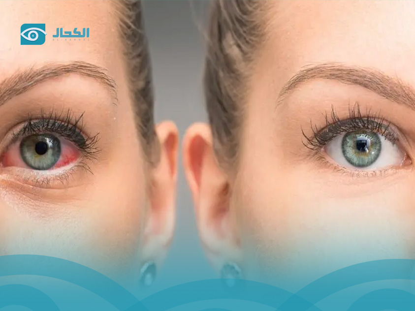 Lasik Eye Surgery Cost In Saudi Arabia