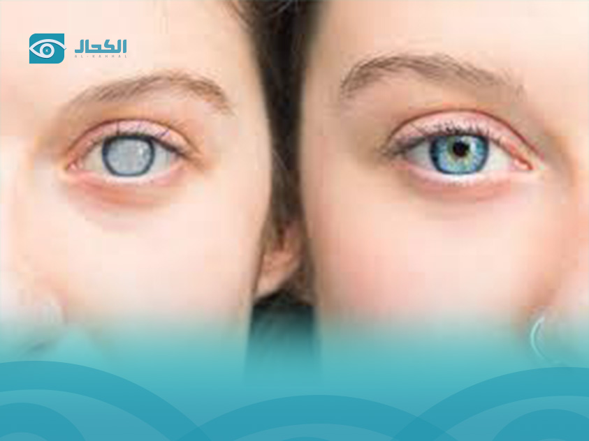 Before and After eye cataract surgery