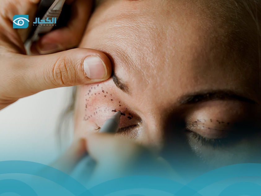 upper-eyelid-surgery