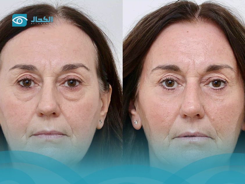 eyelid-surgery-before-and-after