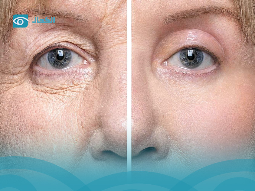 eyelid-surgery-cost