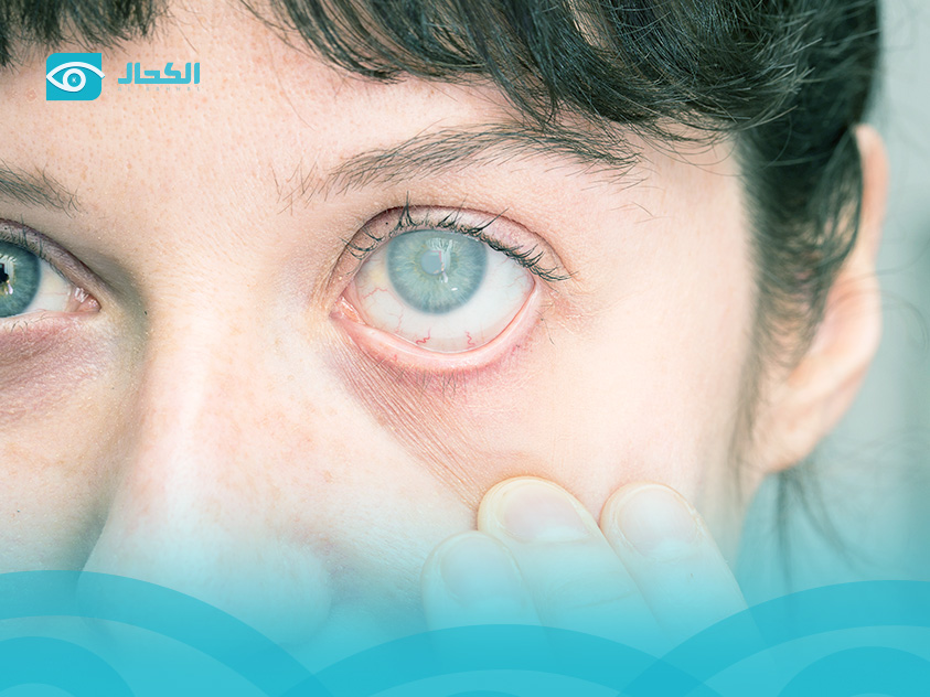 إزالة-غشاء-العين