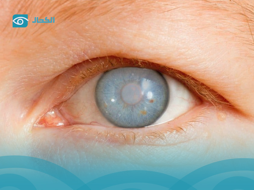what is glaucoma