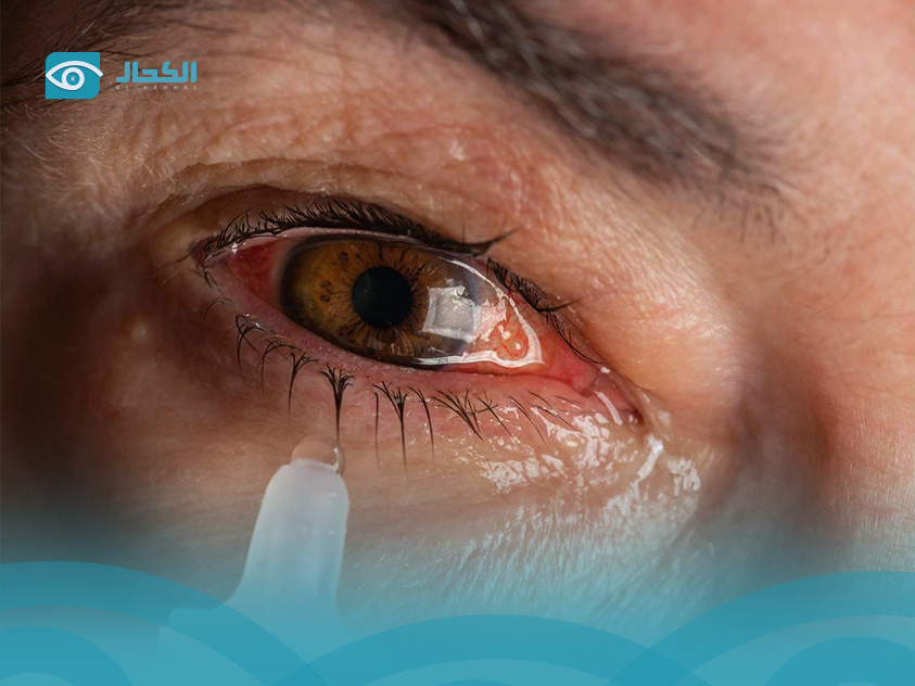 Eye Infection Types