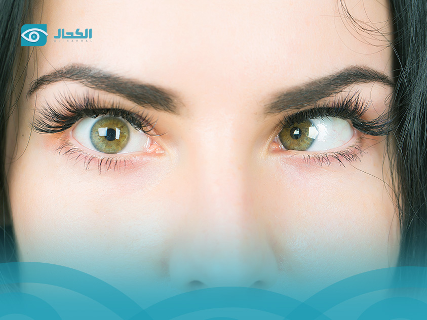 علاج-انحراف-النظر