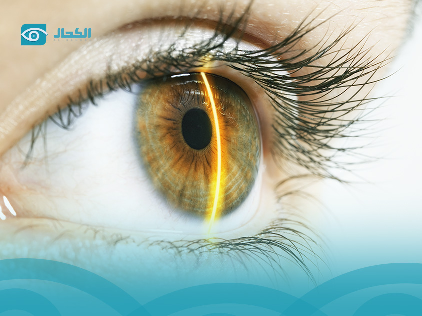 عملية-الكاستم-ليزك