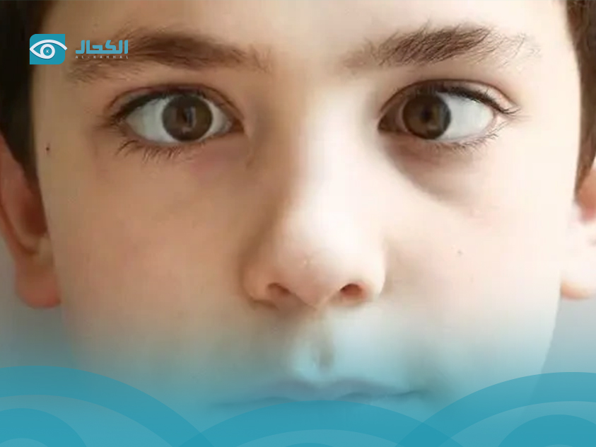 الحول-الوحشي