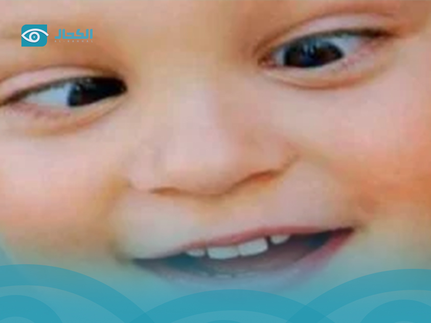 علاج-الحول-الوحشي