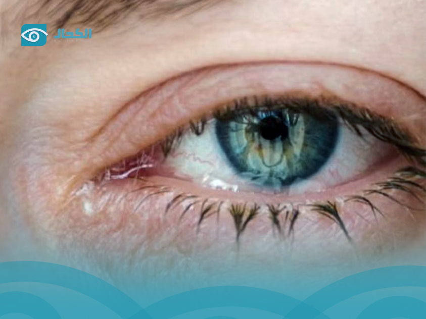 ذبابة-العين ذبابة-العين