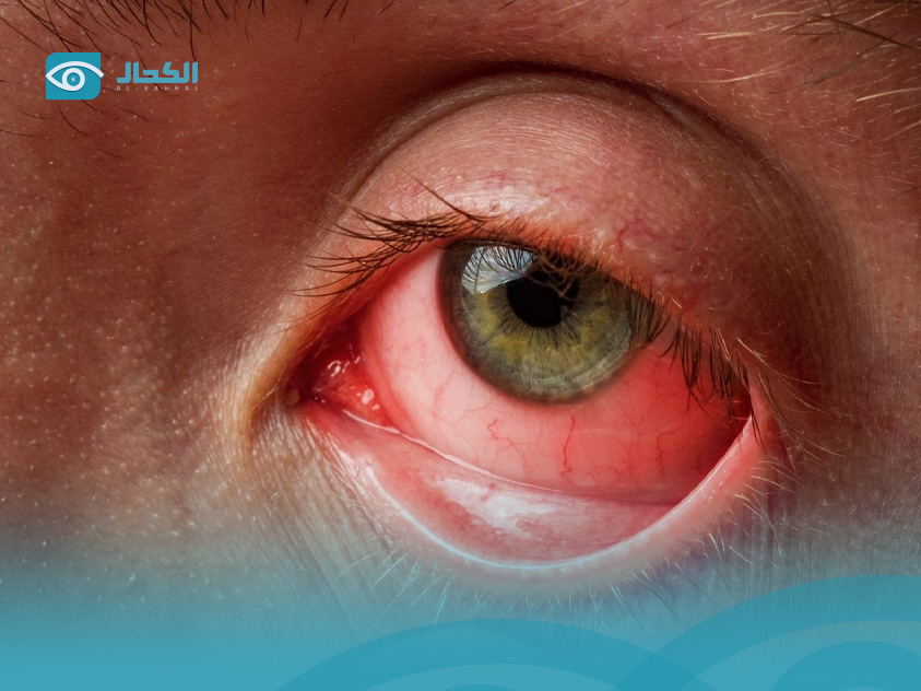 التهاب-الملتحمة-التحسسي  التهاب-الملتحمة-التحسسي