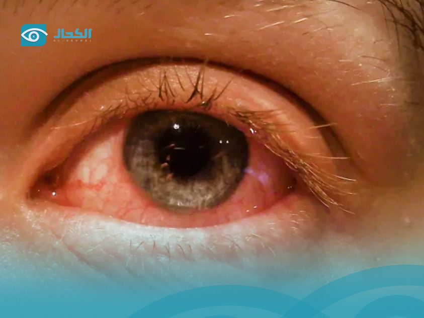 التهاب-الملتحمة-التحسسي  التهاب-الملتحمة-التحسسي