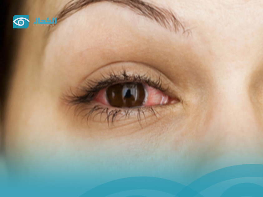 علاج-رمد-العين علاج-رمد-العين