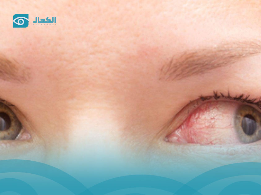 رأرأة-العين رأرأة-العين