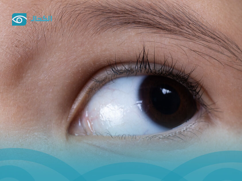 رأرأة-العين رأرأة-العين