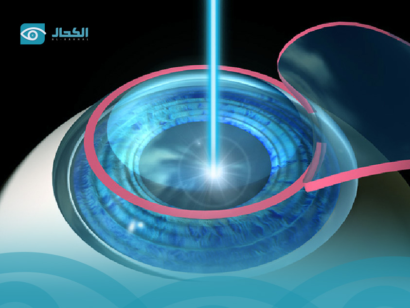 السن-المناسب-لجراحة-العيون-بالليزر