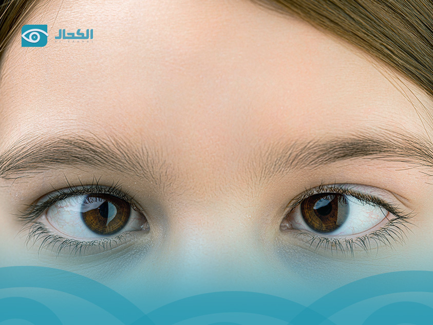 الحول عند الأطفال