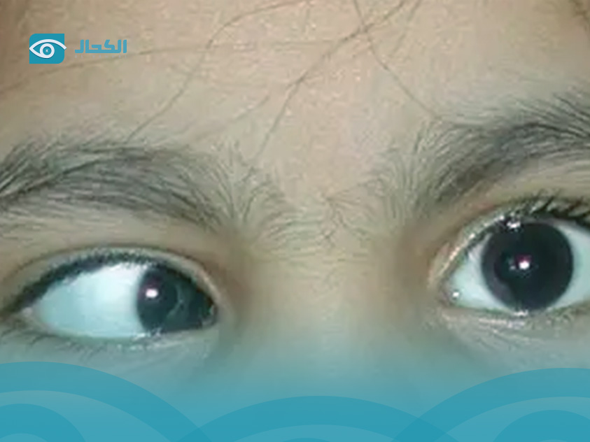 اشكال الحول عند الأطفال