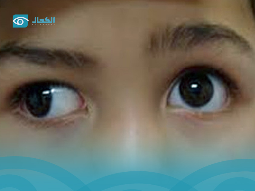 أسباب الإصابة بالحول عند الأطفال