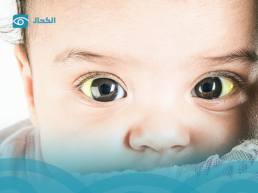 الافرازات الصفراء للعين