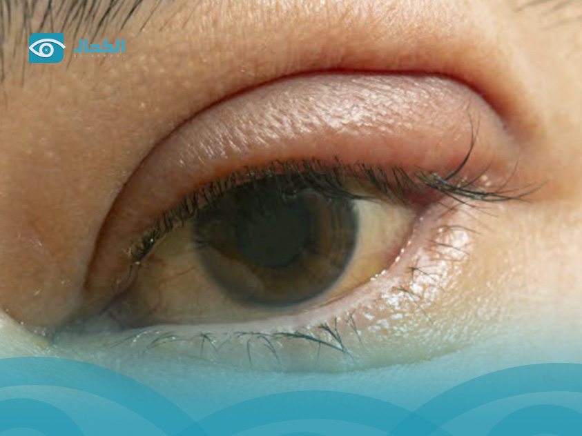 أسباب التهاب الجفون