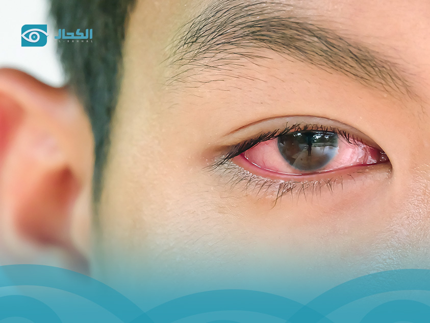 أنواع التهاب العين