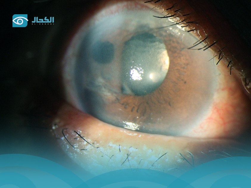 تكلفة علاج الضمور البصري