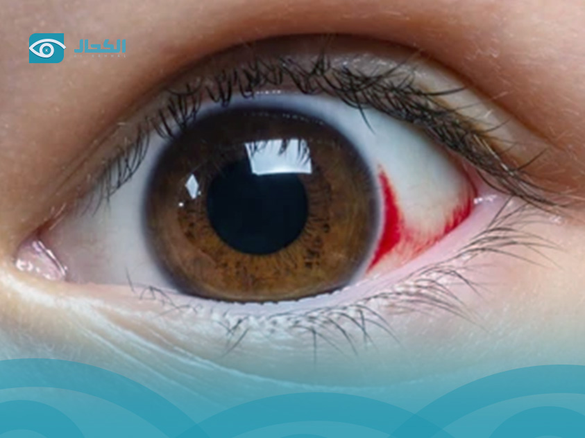 أسباب نزيف العين