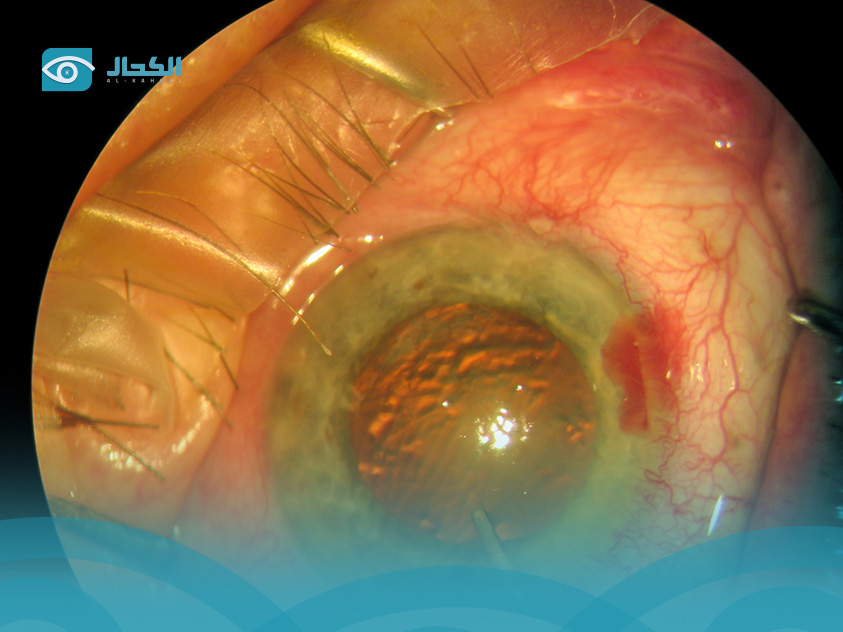 عملية سحب الماء من العين