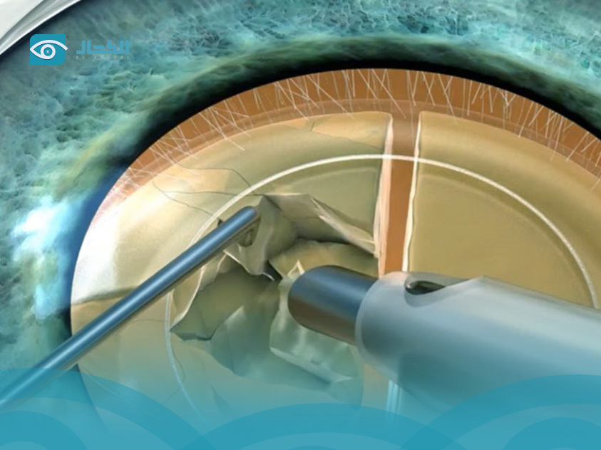 عملية سحب الماء من العين