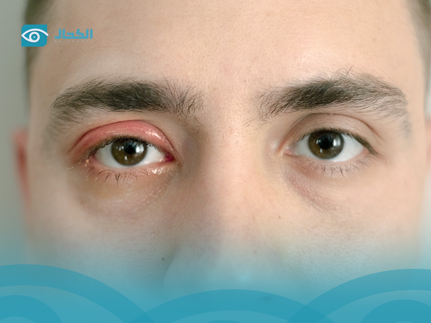 اعراض التهاب الجفن