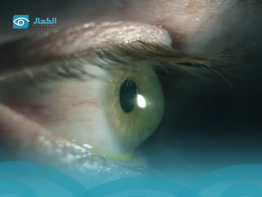 القرنيه المخروطيه