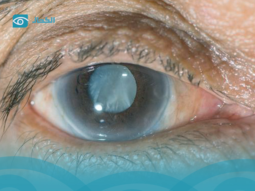 مريض الجلوكوما