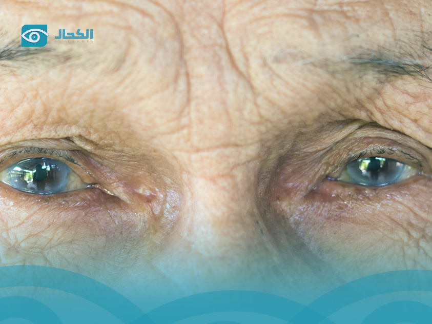 ازالة الساد بالليزر