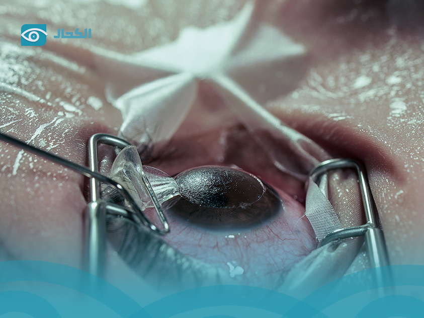 أسعار الفيمتو ليزك في الدمام