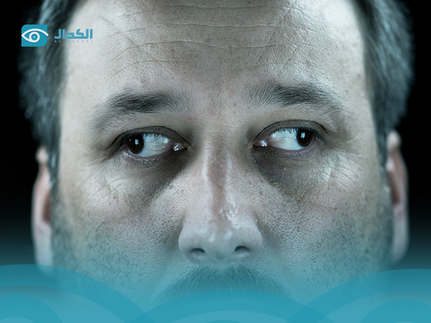 علاج الانحراف في العين