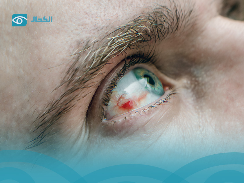 ما-هو-أكثر-أمراض-العيون-انتشاراً