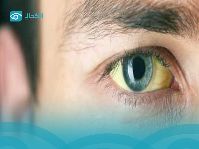 اسباب-صفار-العين-للكبار