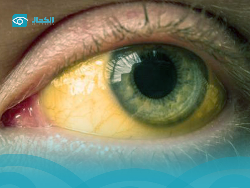 كيف-اتخلص-من-صفار-العين