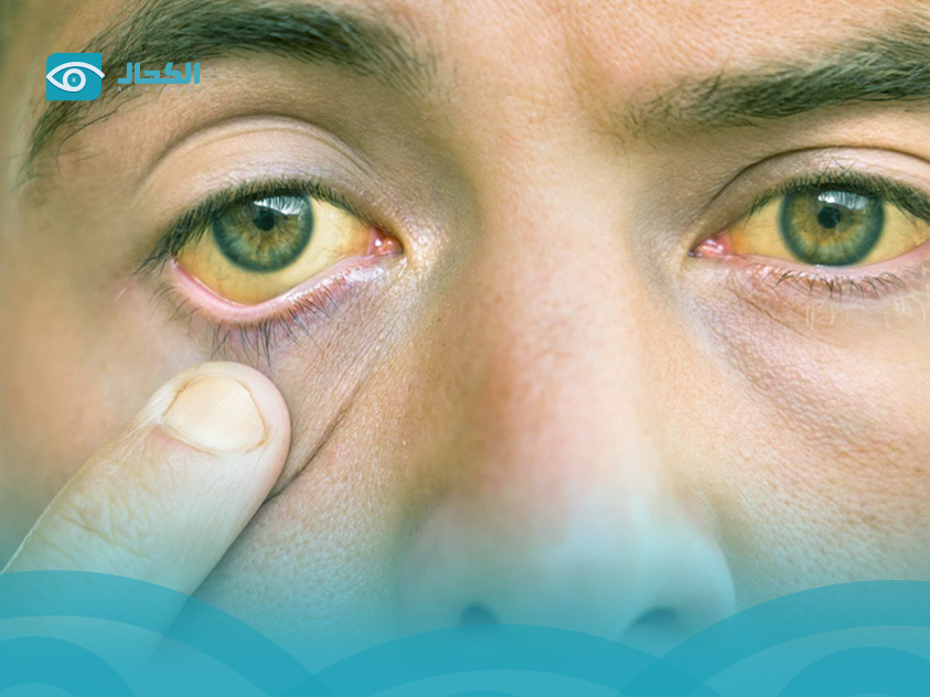 تجربتي-مع-صفار-العين