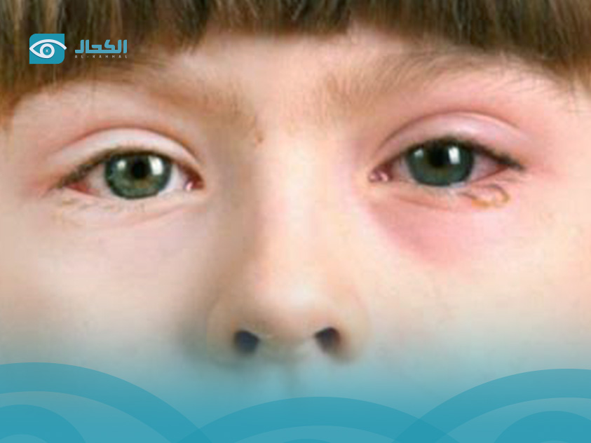 اعراض-جفاف-العين-للاطفال