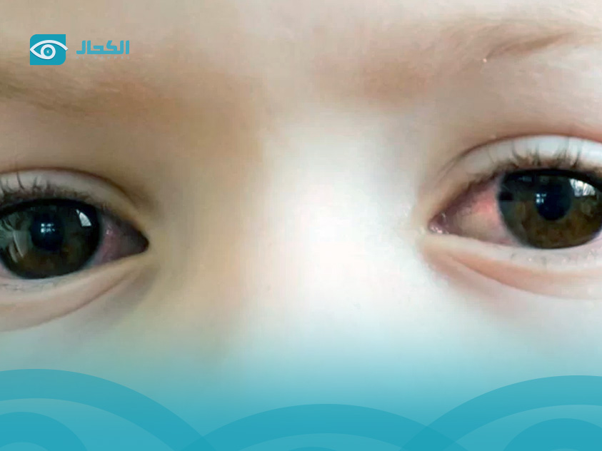 علاج-جفاف-العين-للاطفال